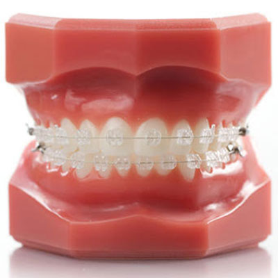 How to Care for New Clear Braces - Gateway Dental Ashburn Virginia