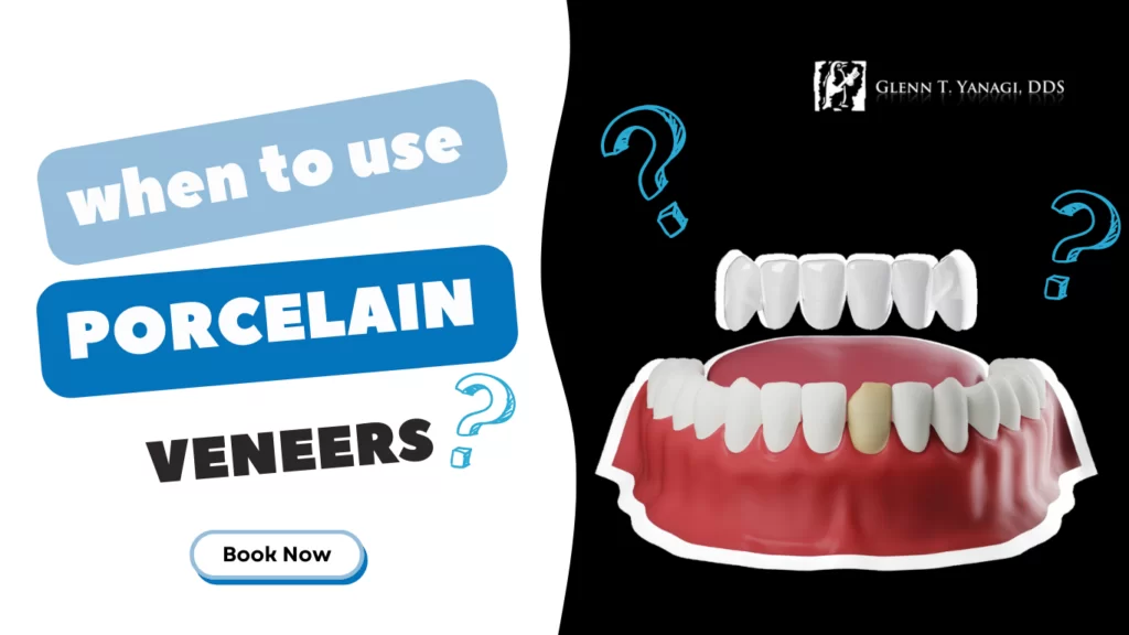 When to use Porcelain Veneers in Irvine, CA